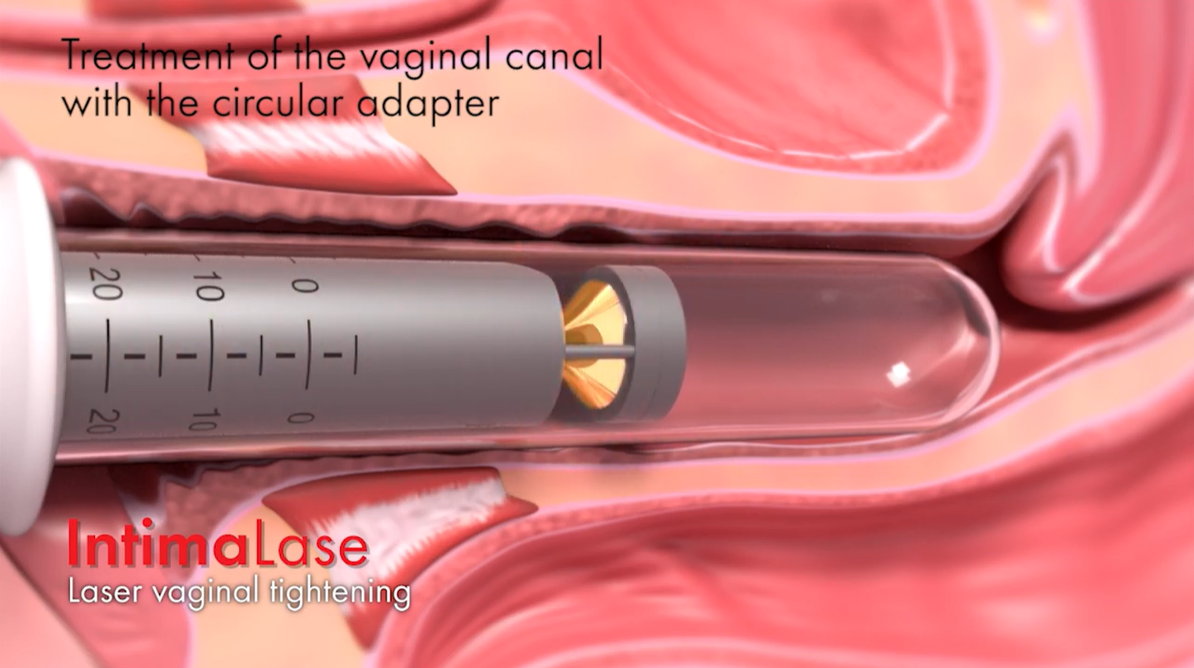 IntimaLase - Rejuvenare vaginala cu laser 