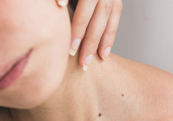 PRP - Terapia Vampir
