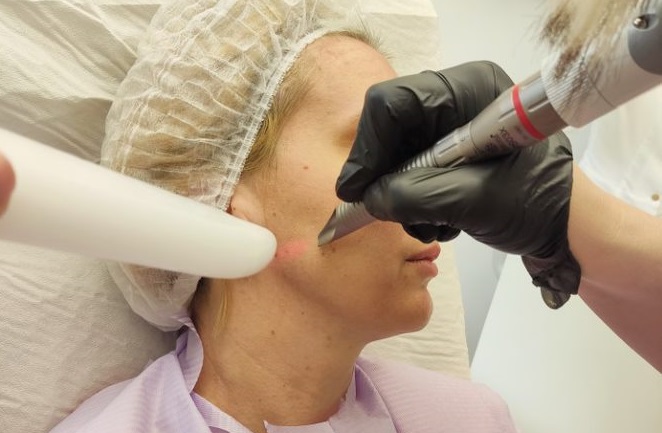 Rejuvenare faciala cu platforma laser SP Dynamis – tehnologia Fotona 4D