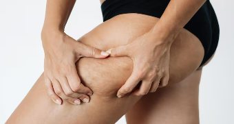 Toskani Celulita edematoasa