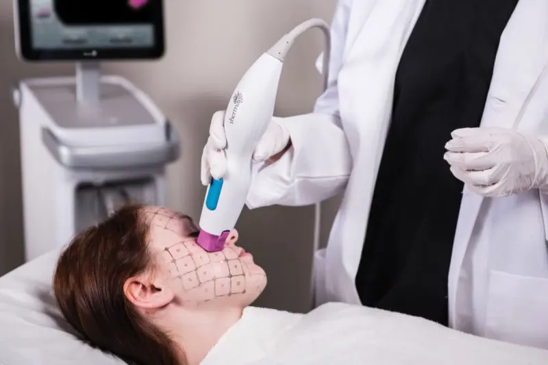 Thermage FLX